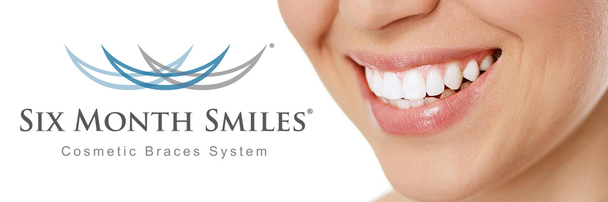 Six Month Smiles Clear Braces System